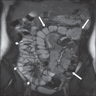 Findings beyond Crohn's disease encountered on magnetic resonance enterography: a pictorial review of diseases and outside the bowel | SMJ