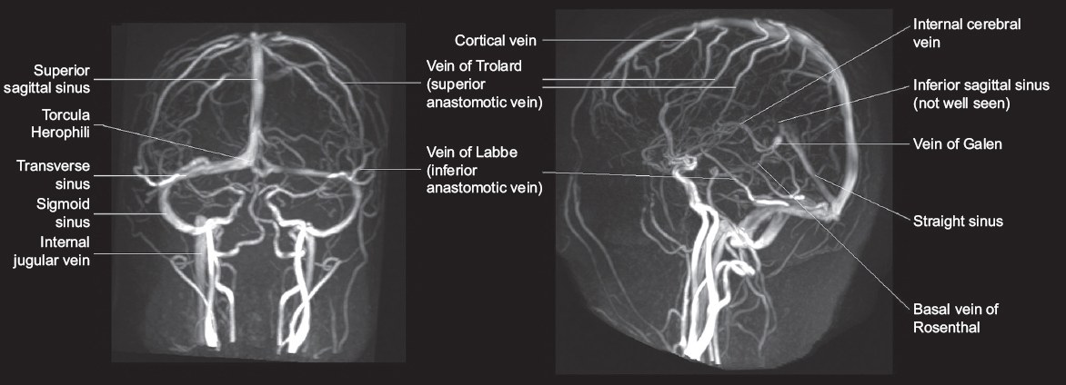 Cerebral Venous Thrombosis A Spectrum Of Imaging Findings Smj